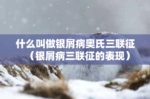 什么叫做银屑病奥氏三联征（银屑病三联征的表现）