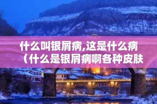 什么叫银屑病,这是什么病（什么是银屑病啊各种皮肤病图片）
